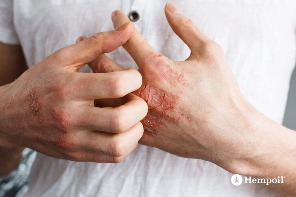 symptoms on the hands from psoriasis and treatment.
